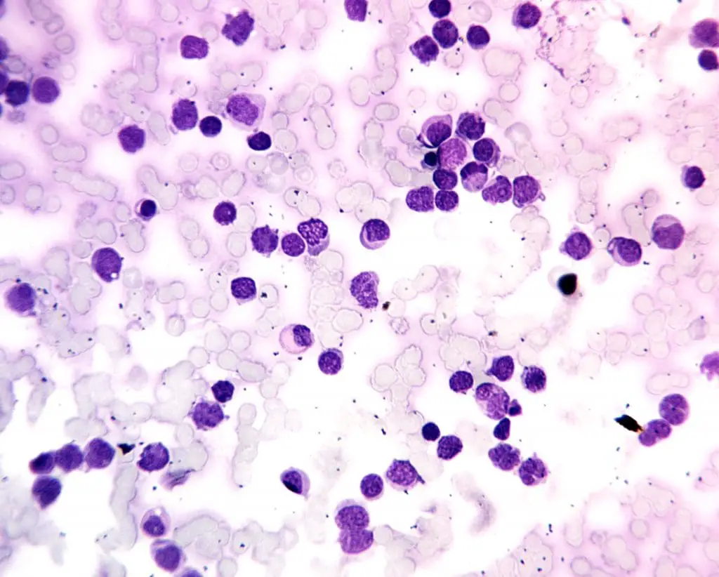 Peripheral blood smear showing numerous nucleated red blood cells and dysplastic myeloblasts. (M6 AML). 