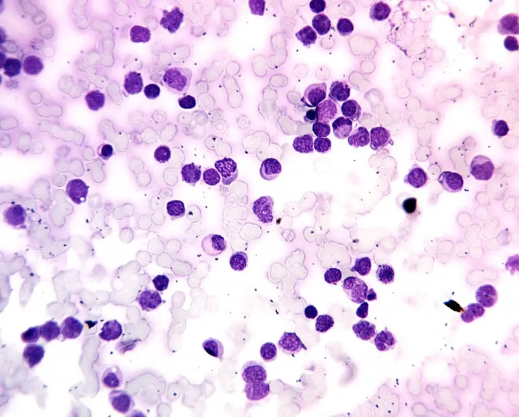 Peripheral blood smear showing numerous nucleated red blood cells and dysplastic myeloblasts. (M6 AML).