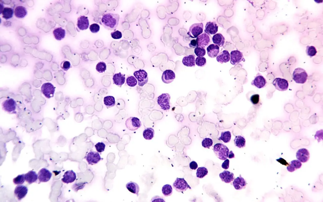 Acute Leukemia: An Overview