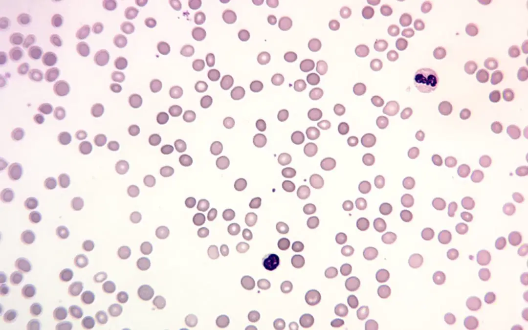 Hereditary Spherocytosis