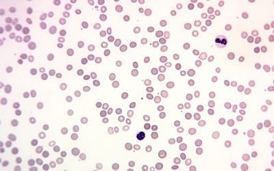 Hereditary Spherocytosis: A spherocytic hemolysis
