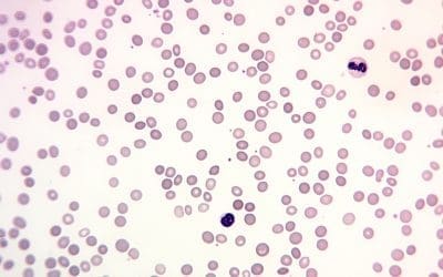 Hereditary Spherocytosis