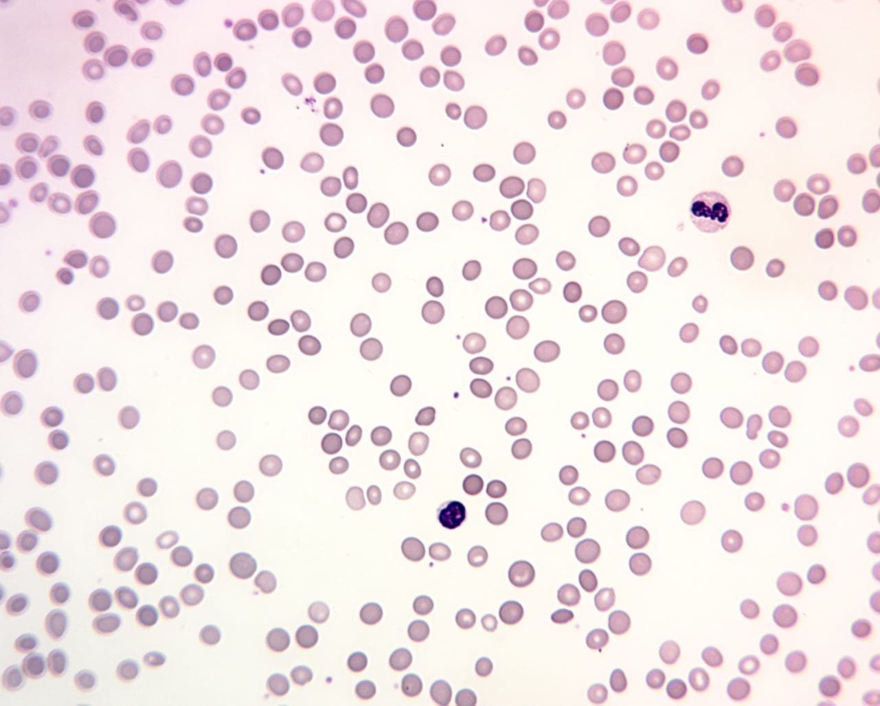 Image displaying a peripheral blood smear of hereditary spherocytosis, showcasing the presence of numerous spherocytes, characterized by their small size, dense staining, and lack of central pallor