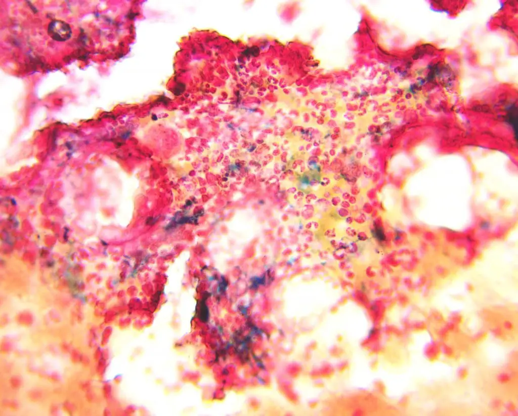 Revealing Iron Stores in Bone Marrow: Positive Perls' Prussian Blue stain highlights Blue-Colored Iron Granules (x400 Magnification). Absence of iron stores highlights an underlying condition like iron deficiency anemia while an abundance of the blue deposits could be indicative of hemochromatosis