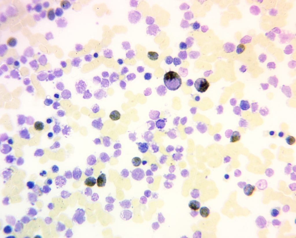 Myeloperoxidase Reaction (MPO) stain in a bone marrow aspirate which shows an abundance of abnormal blasts with bluish brown coloring indicative of AML.