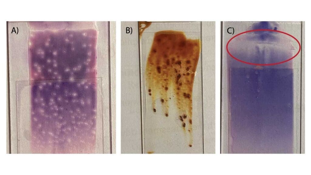Technical problems of peripheral blood smears.