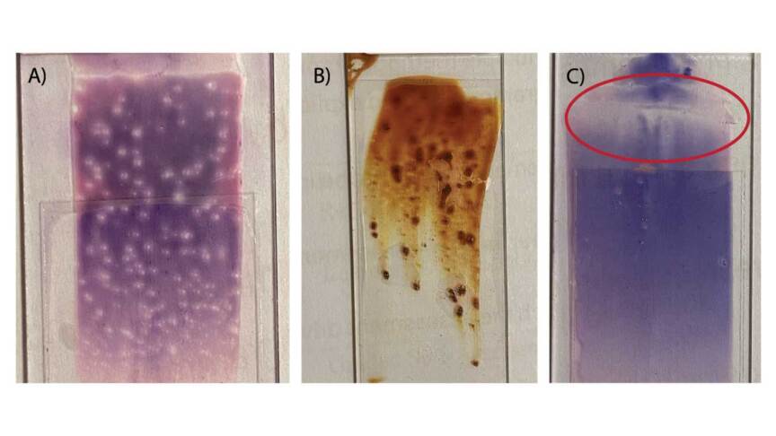 Panel Smearing Preparation of Peripheral Blood Smear: The Do's and Don't's