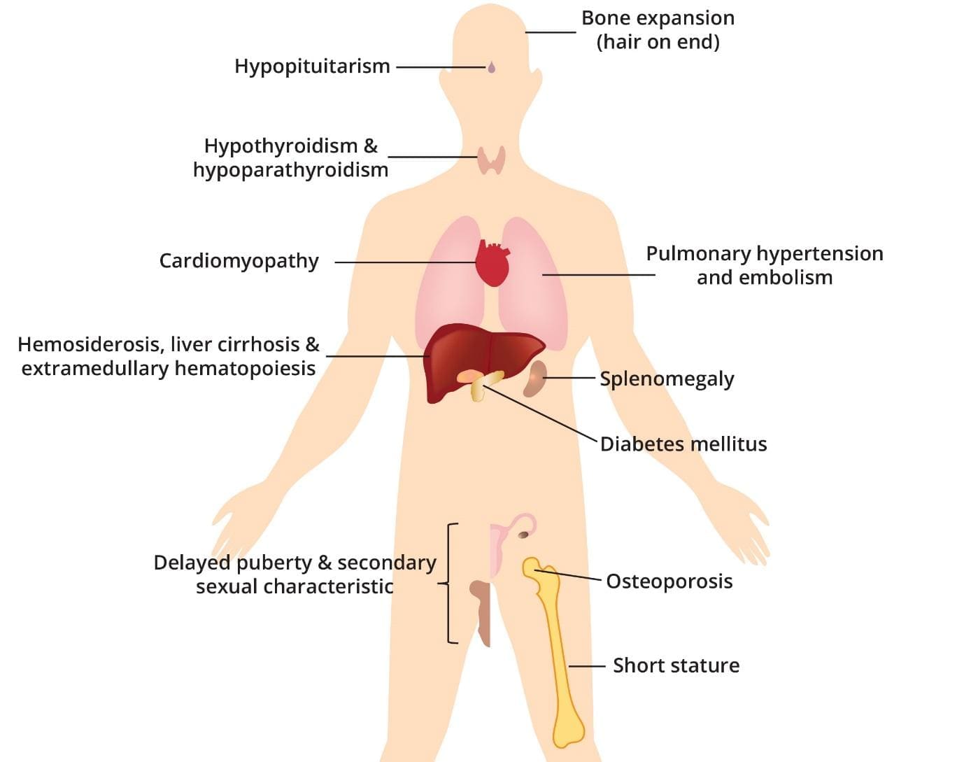 Image depicting the organ damage caused by beta-thalassemia major, highlighting the impact of iron overload on various organs