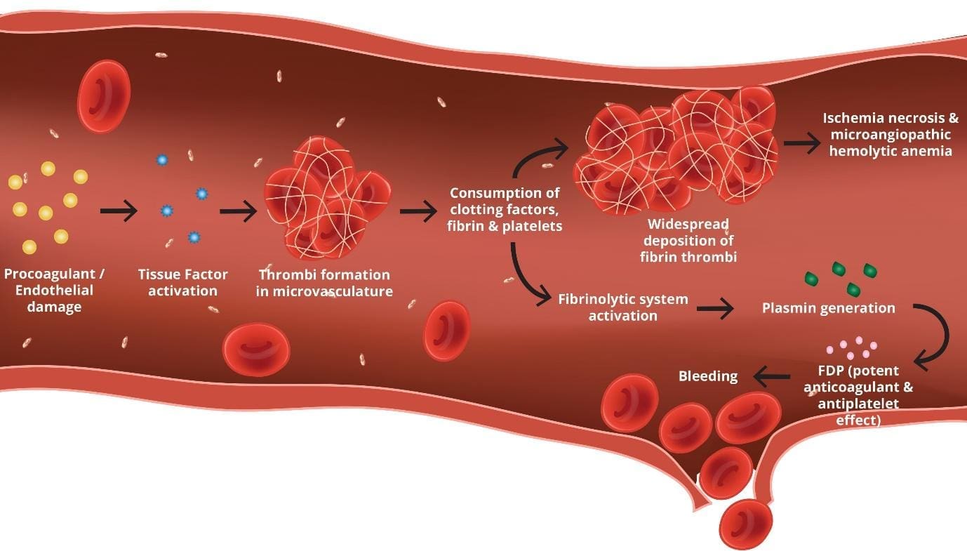 Unveiling the Devastating Cascade of DIC: A Microscopic Journey through Hemolysis, Thrombosis, and Platelet Consumption