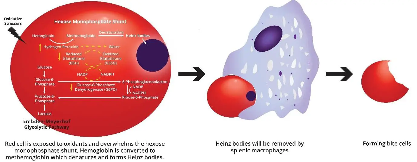 Image showcasing the mechanism of hemolysis in a G6PD deficiency crisis, highlighting the role of oxidative stress in damaging red blood cell membranes. The diagram describes a red blood cell in G6PD deficiency experiencing oxidative stress, triggering formation of Heinz bodies and removal by the spleen, creating bite cells and leading to hemolytic anemia. #G6PDdeficiency #HemolyticAnemia