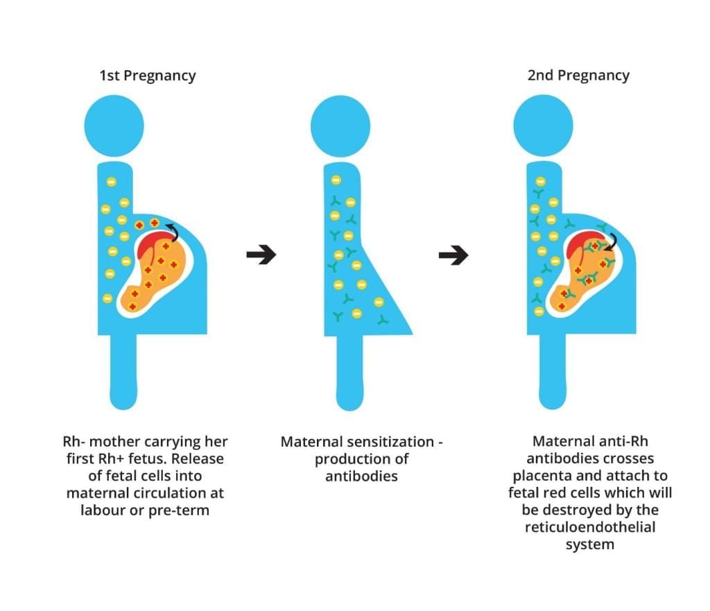 This image highlights the pathogenesis of HDN, revealing the crucial role of Rh incompatibility in triggering maternal antibody production and causing fetal hemolysis.