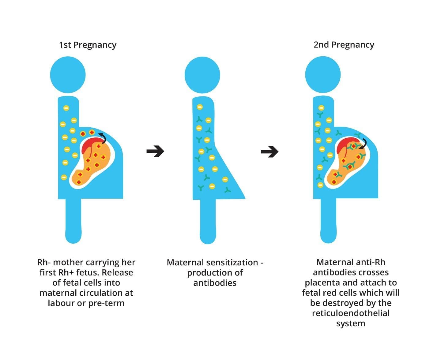 Hemolytic disease of the newborn, Rh incompatibility, ABO incompatibility, hemolysis, anemia