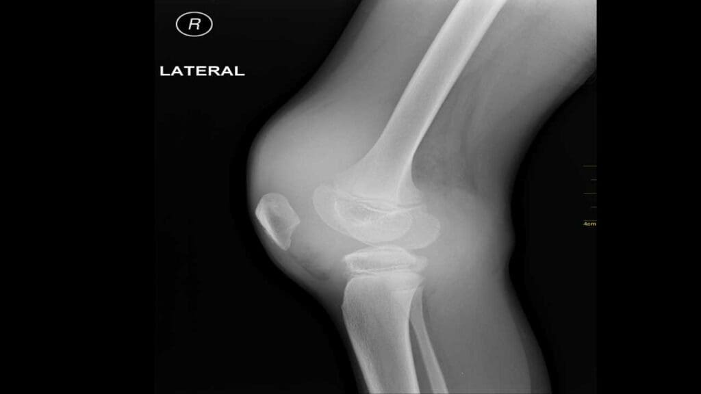 X-ray of hemarthrosis of the right knee joint.