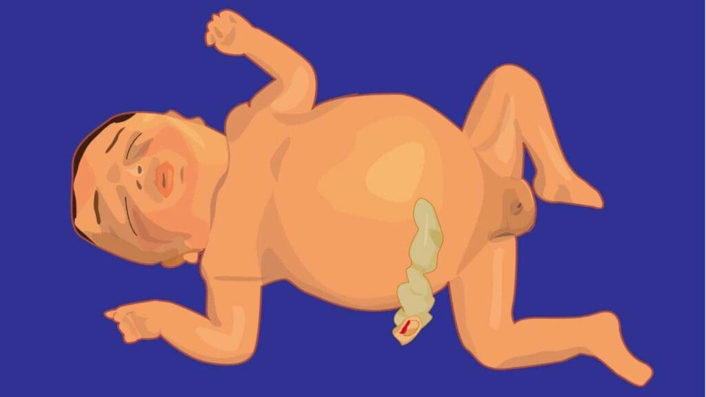 An illustration of a newborn infant with severe hemolytic disease (erythroblastosis fetalis) resulting in hydrops fetalis