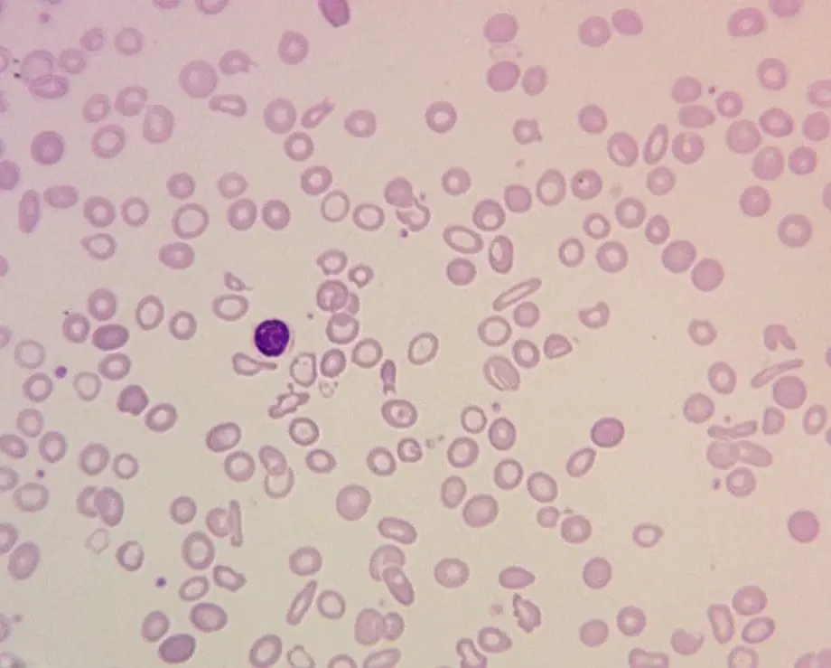 A peripheral blood smear of iron deficiency anemia patient with hypochromic microcytic cells, anisopoikilocytosis and pencil-shaped cells.