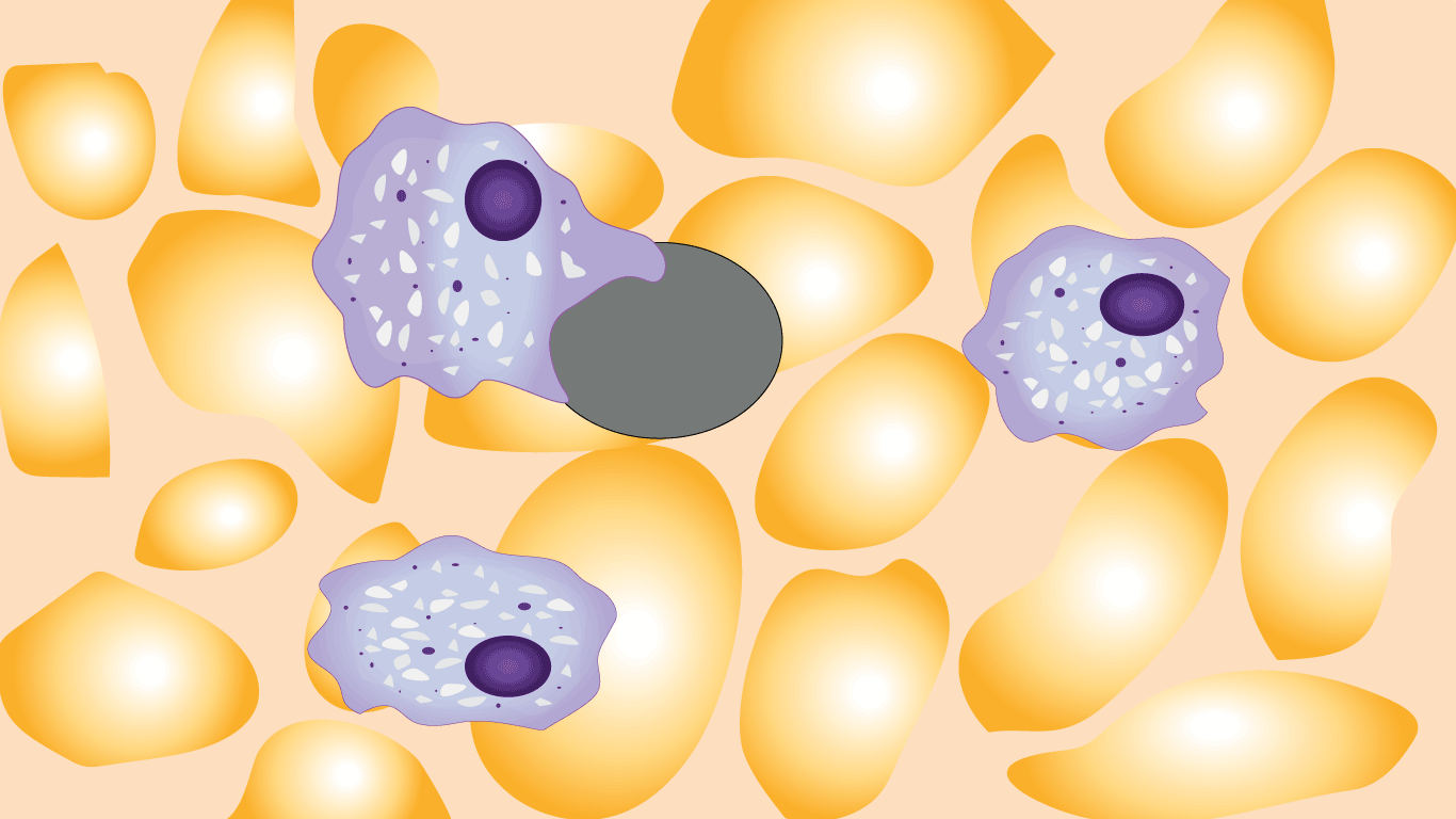 Image depicting macrophages engulfing platelets, highlighting the immune-mediated destruction of platelets in immune thrombocytopenic purpura (ITP)