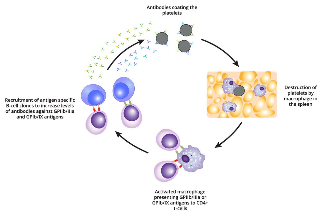 A Microscopic View of Platelet Destruction. Image depicting macrophages engulfing platelets coated in antibodies, illustrating the autoimmune-mediated destruction of platelets in immune thrombocytopenic purpura (ITP)