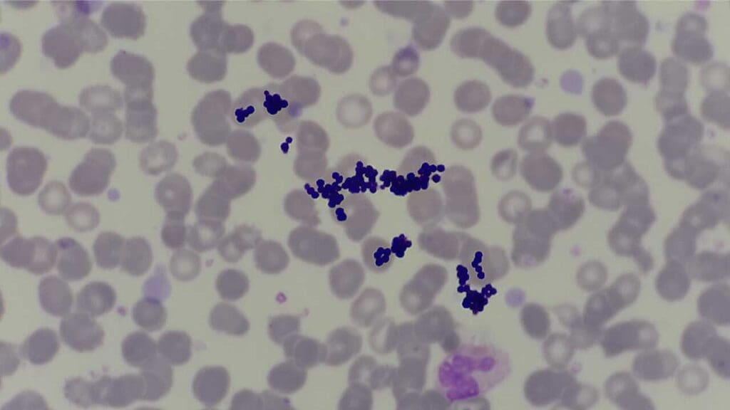 In a Leishman-stained peripheral blood smear, stain deposits can sometimes appear similar to Gram-positive cocci bacteria if the stain is not filtered properly