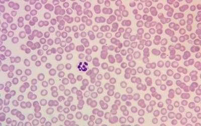 Megaloblastic Anemia