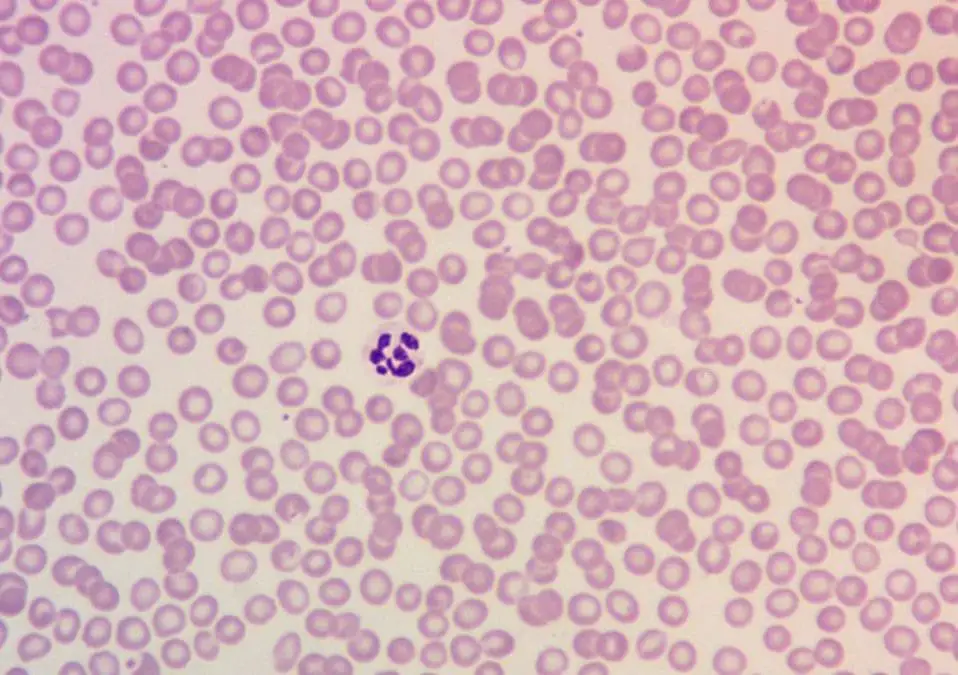 Megaloblastic Anemia