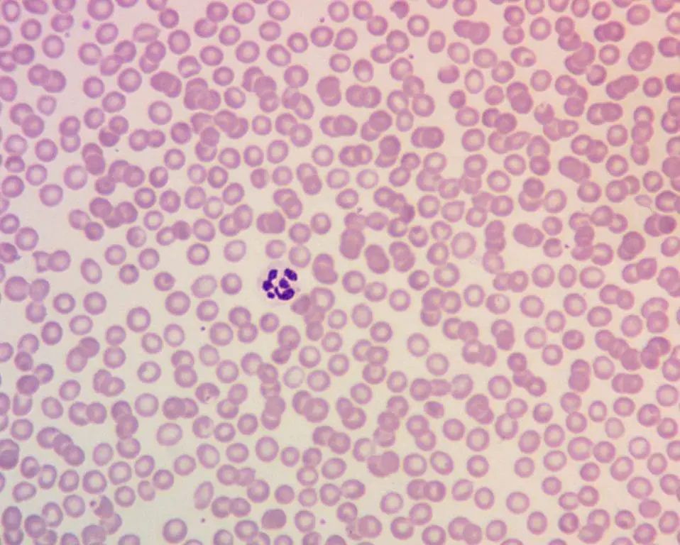 Image depicting a peripheral blood smear from a patient with megaloblastic anemia, highlighting the presence of hypersegmented neutrophils with six or more lobes