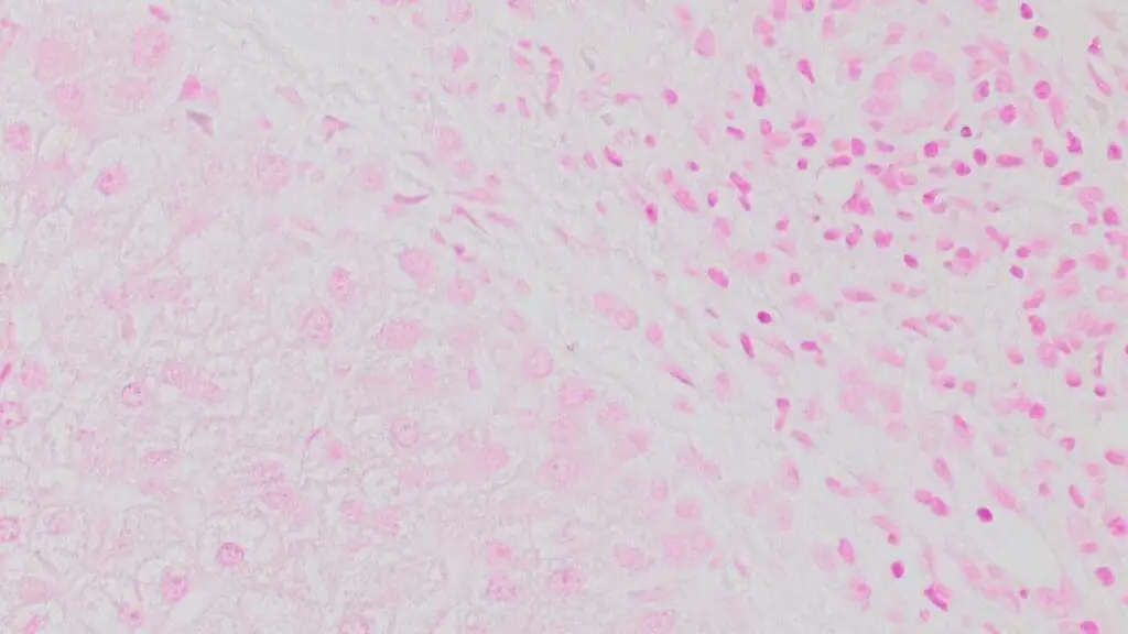 Liver biopsy of chronic alcoholic cirrhosis stained using Prussian Blue Stain showed no evidence of iron overload.