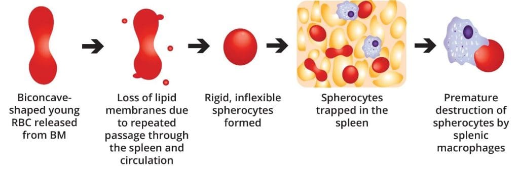Image depicting a microscopic view of red blood cells undergoing hemolysis in hereditary spherocytosis, highlighting the role of membrane defects and mechanical stress