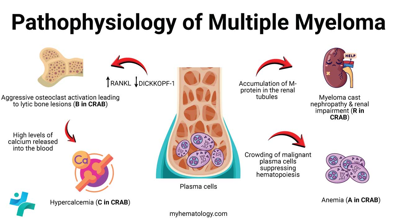 The pathophysiology of Multiple Myeloma (MM) leading to the CRAB features stems from the unchecked proliferation of clonal, malignant plasma cells in the bone marrow, which secrete a non-functional monoclonal immunoglobulin (M-protein). This proliferation creates a vicious cycle within the bone marrow microenvironment: the myeloma cells induce bone damage by increasing the expression of RANKL while downregulating osteoblast activity (DICKKOPF-1), leading to aggressive osteoclast activation, which causes Lytic bone lesions (the 'B' in CRAB) and releases high levels of calcium into the blood, resulting in Hypercalcemia (the 'C' in CRAB). The accumulation of the M-protein (particularly light chains, known as Bence-Jones proteins) can overwhelm the renal tubules, leading to myeloma cast nephropathy and subsequent Renal impairment (the 'R' in CRAB). Simultaneously, the crowding of the marrow by the malignant plasma cells, coupled with the inhibitory effects of inflammatory cytokines on normal hematopoiesis, suppresses the production of healthy blood cells, manifesting most commonly as Anemia (the 'A' in CRAB).