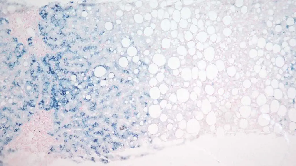 The liver biopsy showed Grade 3 iron accumulation in hepatocytes, distributed in an acinar pattern, which is characteristic of homozygous genetic hemochromatosis. (Perl's Prussian Blue Stain: ×10).