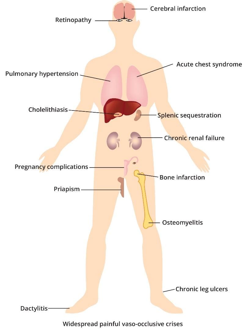 Image highlighting the various complications of sickle cell anemia, including cerebral infarction, blindness, acute chest syndrome, pulmonary hypertension, and others