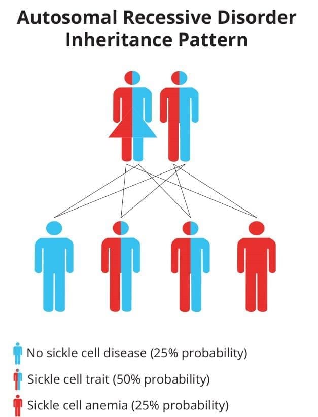 Image depicting an illustration of the autosomal recessive inheritance pattern of sickle cell anemia, highlighting the contribution of one mutated gene from each parent