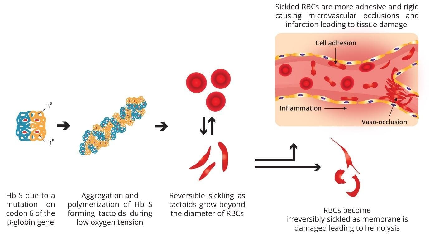 Image showcasing the genetic mutation on codon 6 of the beta-globin gene, leading to the formation of sickle-shaped red blood cells and vaso-occlusion