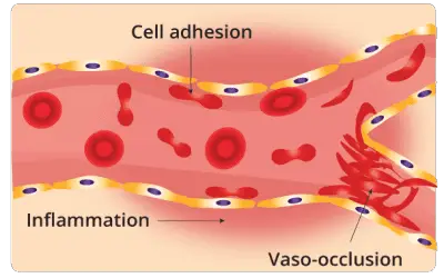 Sickle Cell Anemia