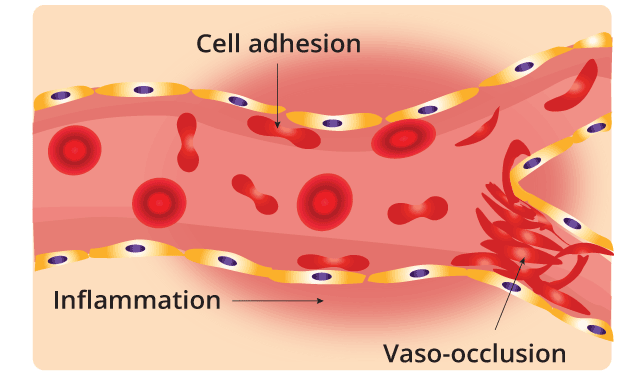 Image depicting a microscopic view of sickle cell anemia vaso-occlusion, highlighting the role of deformed red blood cells in obstructing blood flow