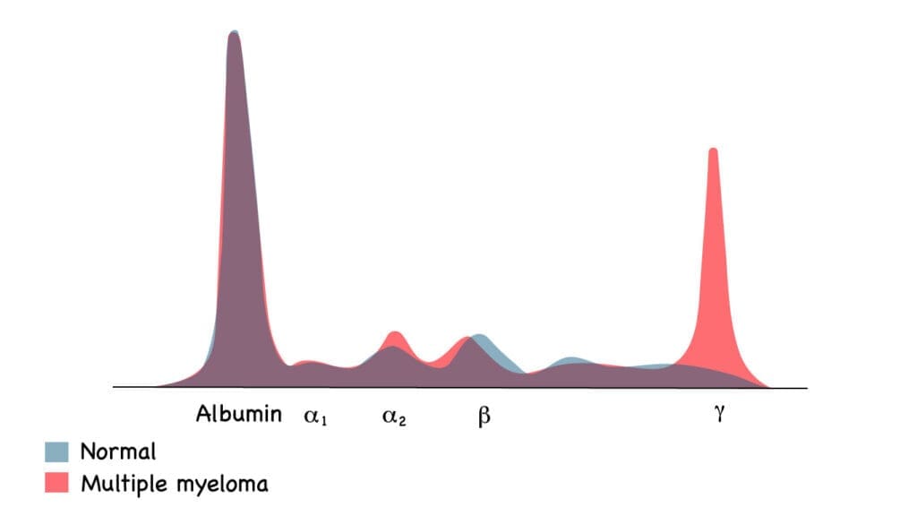 Serum protein electrophoresis showing the abnormal M protein spike in the gamma region in multiple myeloma