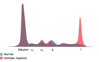 Smoldering Multiple Myeloma (SMM)