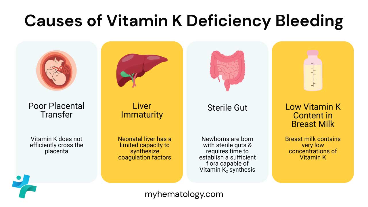 Causes of Vitamin K Deficiency Bleeding or VKDB includes poor placental transfer, liver immaturity, sterile gut and low vitamin K content in breast milk