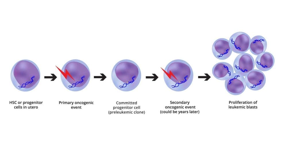 Image illustrating the two-step oncogenic model of ALL pathogenesis, including the initial genetic alterations and the subsequent epigenetic and transcriptional changes