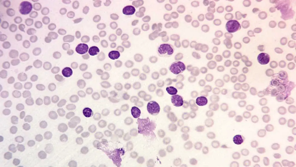 Acute lymphoblastic leukemia or ALL peripheral blood smear with lymphoblasts and some smudge cells and also normochromic normocytic anemia and thrombocytopenia at x 400 magnification.