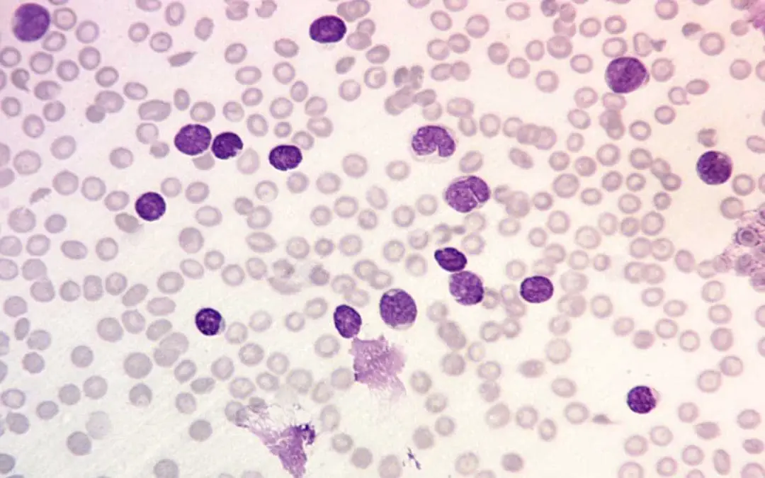 B-cell Acute Lymphoblastic Leukemia (B-ALL)