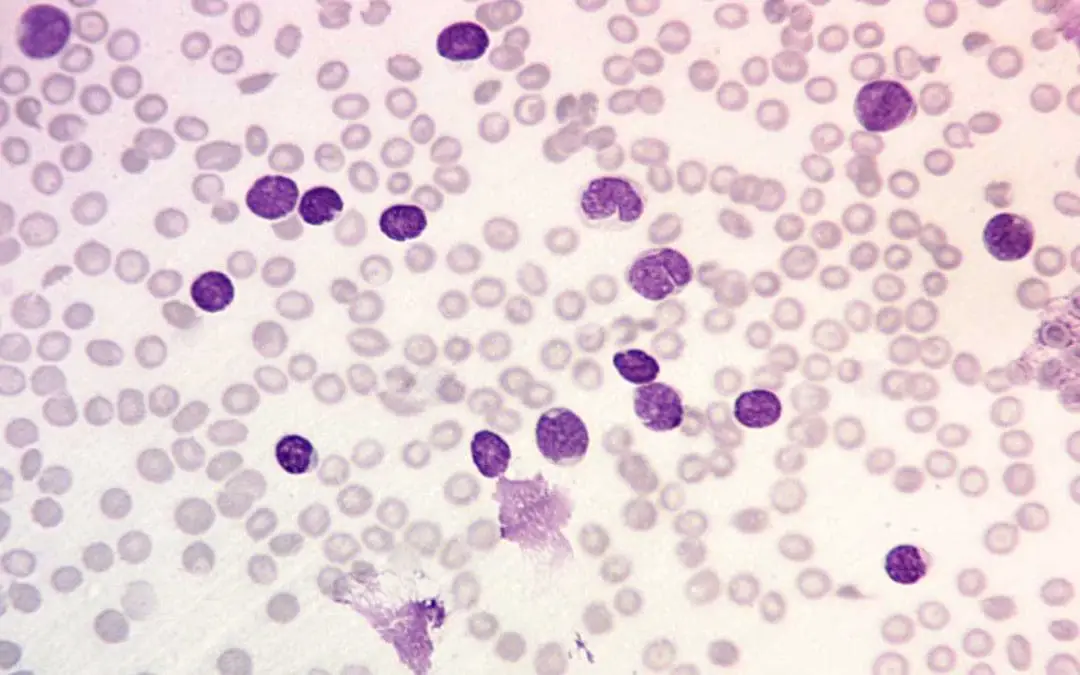 B-Cell Acute Lymphoblastic Leukemia (B-ALL)