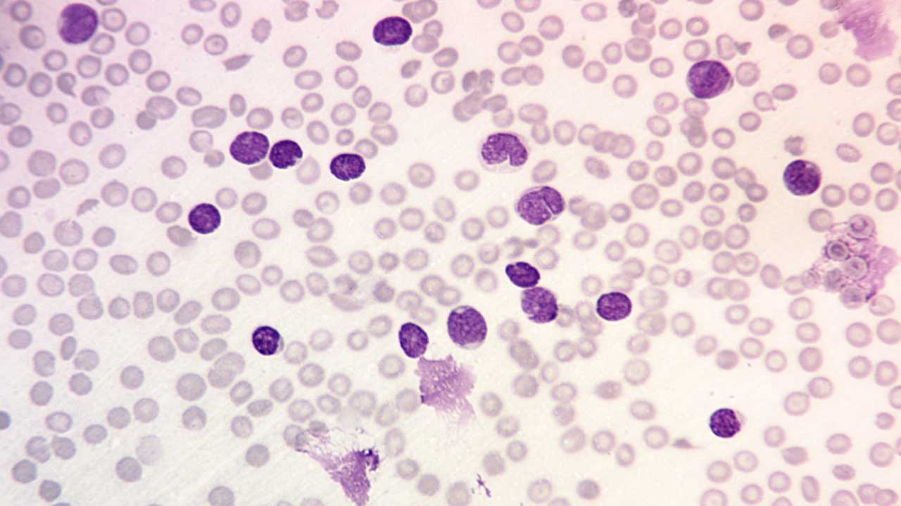 ALL peripheral blood smear with lymphoblasts and some smudge cells and also normochromic normocytic anemia and thrombocytopenia x 400 magnification. 