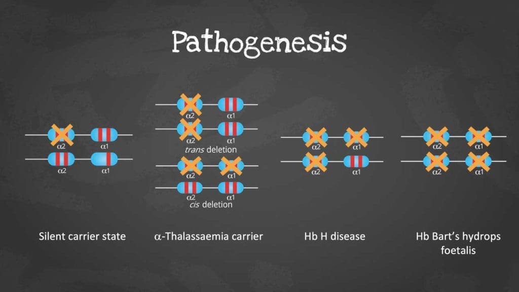 Alpha thalassemia severity scale based on the number of mutated alpha-globin genes