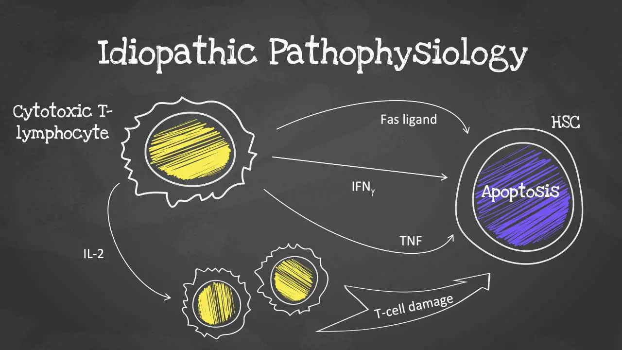 An illustration depicting the autoimmune assault on hematopoietic stem cells by cytotoxic T-cells, leading to the bone marrow failure characteristic of idiopathic aplastic anemia.