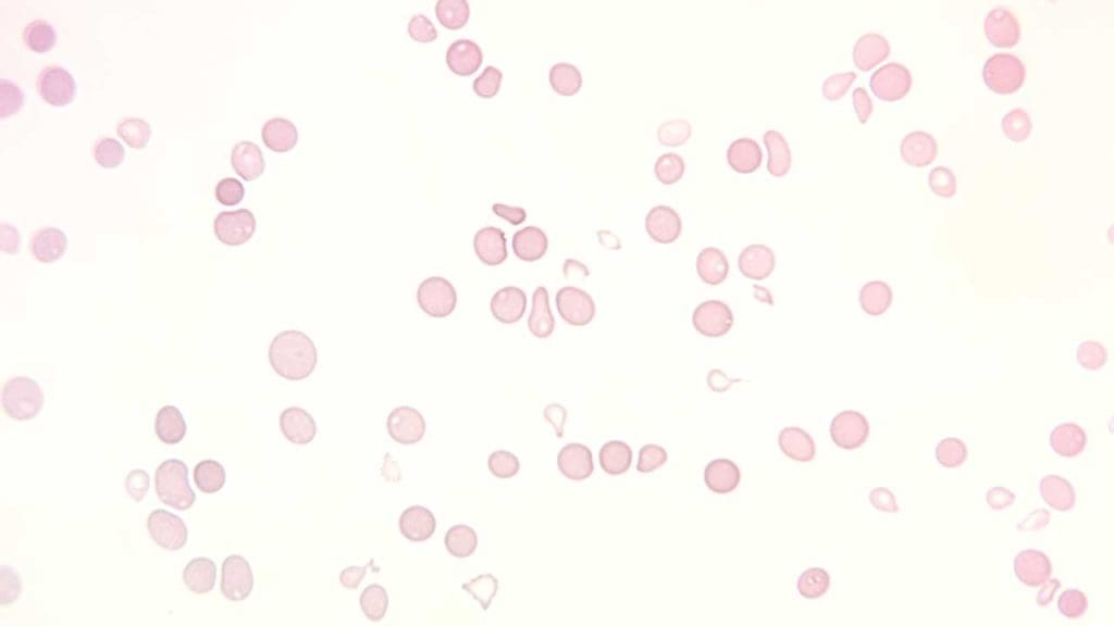 Non-cancerous blood disorder in hemato-oncology: Aplastic anemia peripheral blood smear at 400x magnification showcasing markedly reduced numbers of mature red blood cells, white blood cells, and platelets, reflecting the disease's hallmark pancytopenia.