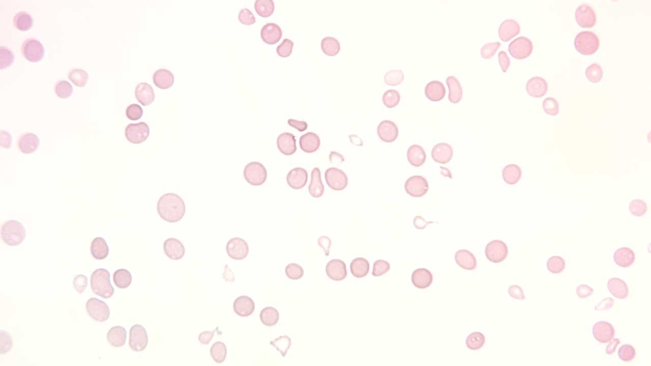 Aplastic anemia peripheral blood smear at 400x magnification showcasing markedly reduced numbers of mature red blood cells, white blood cells, and platelets, reflecting the disease's hallmark pancytopenia.