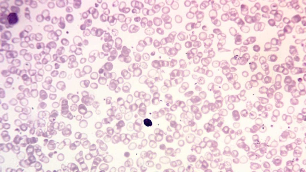 Unveiling the Hallmarks of Thalassemia Major: A Microscopic Portrait of Anisocytosis, Target Cells, and Nucleated Red Blood Cells