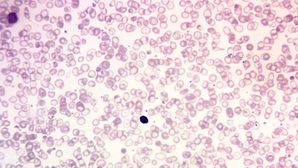 Unveiling the Hallmarks of Beta-Thalassemia Major: A Microscopic Portrait of Anisocytosis, Target Cells, and Nucleated Red Blood Cells