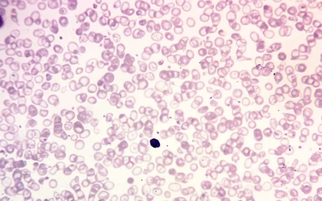 β-Thalassemia: A diverse hemoglobin disorder