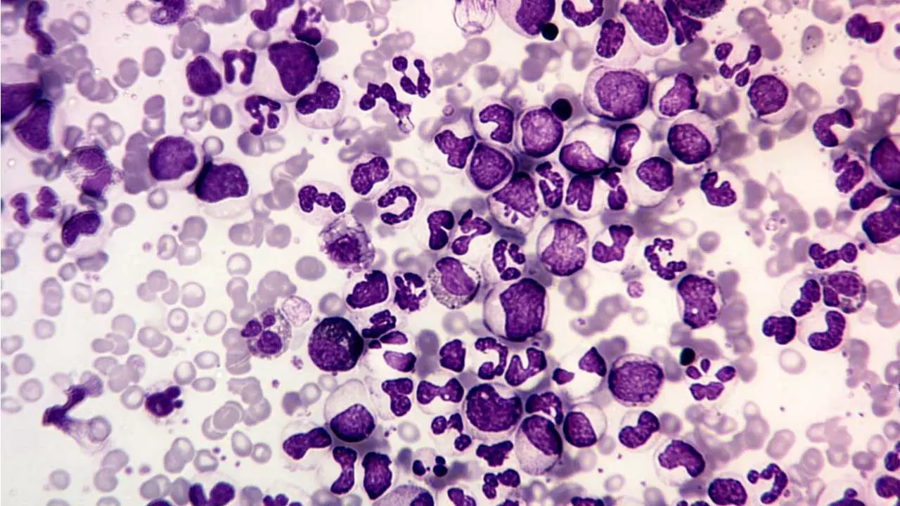 Image depicting a peripheral blood smear of chronic myeloid leukemia (CML), showcasing leukocytosis with immature granulocytes, basophilia, and eosinophilia